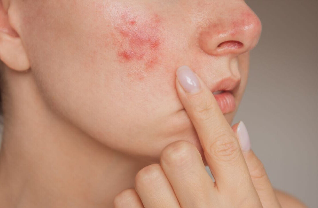 En tjej med acne - Removal hjälper dig att reducera acne